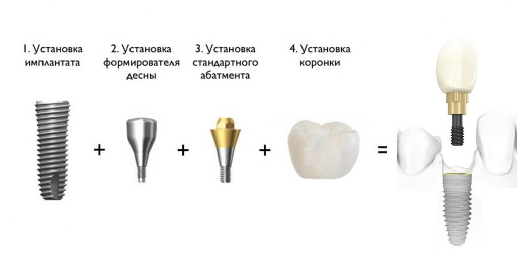 Этапы протезирования на имплантах